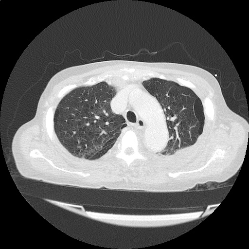 ct_chest_anemia_06